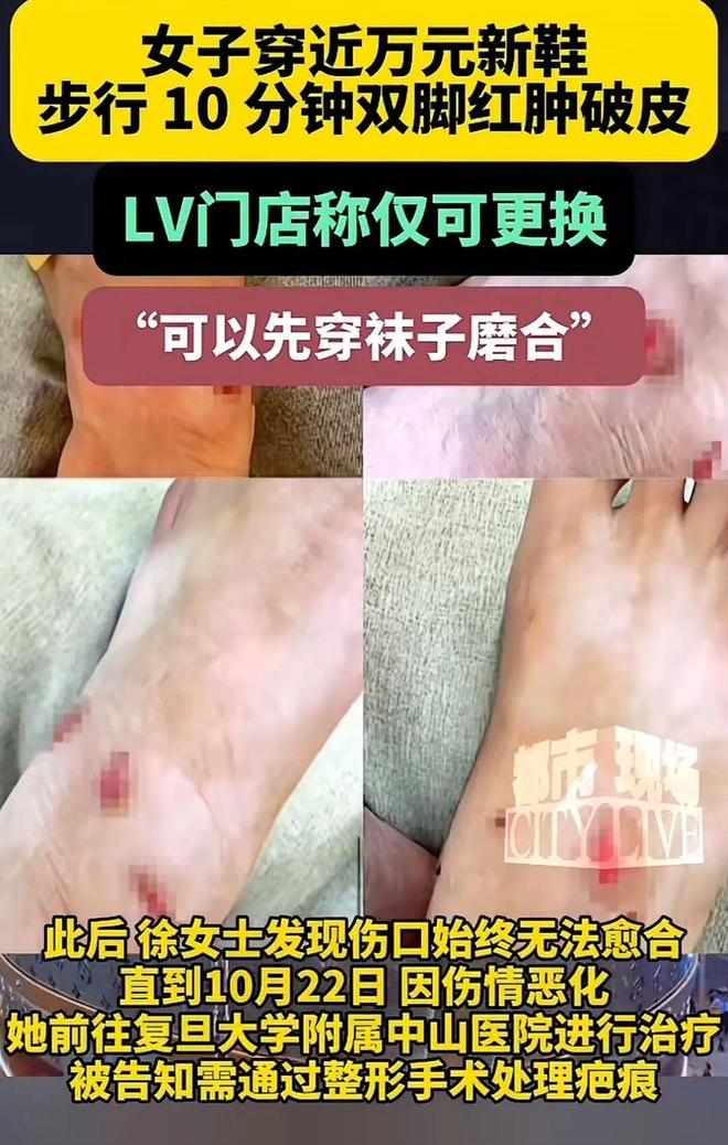 10分钟双脚红肿破皮女子穿近万元新鞋步行(图2)